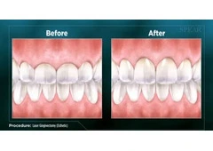 Get a Perfect Smile with Same-Day Crowns in Las Vegas!