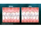 Get a Perfect Smile with Same-Day Crowns in Las Vegas!