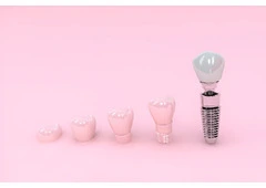 Hex Abutments Implants: Perfect for Long-Term Results