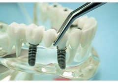 Investing in Dental Implant Research and Development