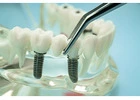 Investing in Dental Implant Research and Development