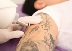 Laser Tattoo Removal Near Me Altamonte Springs