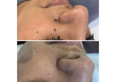 Skin tag removal clinic Goodmayes