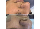 Skin tag removal clinic Goodmayes
