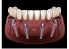 All-on-4 Dental Implants in Tijuana, Mexico – Affordable, Life-Changing Results!