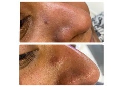 Skin tag removal clinic Goodmayes