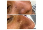 Skin tag removal clinic Goodmayes
