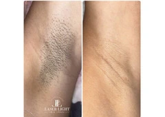 Laser hair removal east London