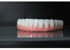 Full Mouth Dental Implants in Mexico with Teeth Savers