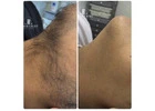 Laser hair removal east London