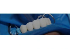 Find Trustworthy Teeth Replacements with Tijuana Dental Implants