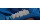 Find Trustworthy Teeth Replacements with Tijuana Dental Implants
