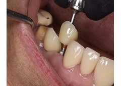 Get that Ideal Smile Makeover from the Best Tijuana Dentist