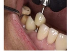 Get that Ideal Smile Makeover from the Best Tijuana Dentist