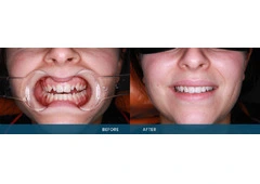 Porcelain Veneers Melbourne Can Transform Your Appearance