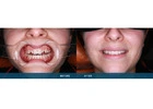 Porcelain Veneers Melbourne Can Transform Your Appearance