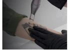 Safe & Effective Tattoo Removal Treatment in Bhubaneswar