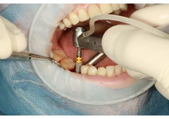 Best Tooth Implant Process Guide for a Smooth Treatment