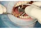 Best Tooth Implant Process Guide for a Smooth Treatment