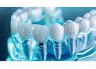 All on 4 Dental Implants and Porcelain Veneers for a Confident Somerset Smile