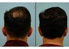 Hair Loss Solutions Dallas | Women’s Thinning Hair Specialist