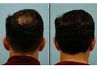 Hair Loss Solutions Dallas | Women’s Thinning Hair Specialist