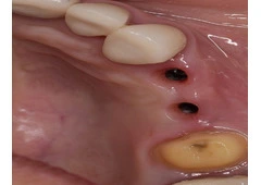 Gum Graft in Tijuana – Restore Your Smile with Expert Care