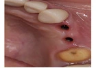 Gum Graft in Tijuana – Restore Your Smile with Expert Care