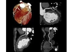Cardiac CT scan Craigieburn