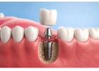 Dental Implants in Perth – Restore Your Smile with Iluka Dental Centre